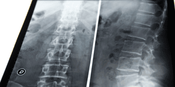 Scoliosis: Breaking down the basics