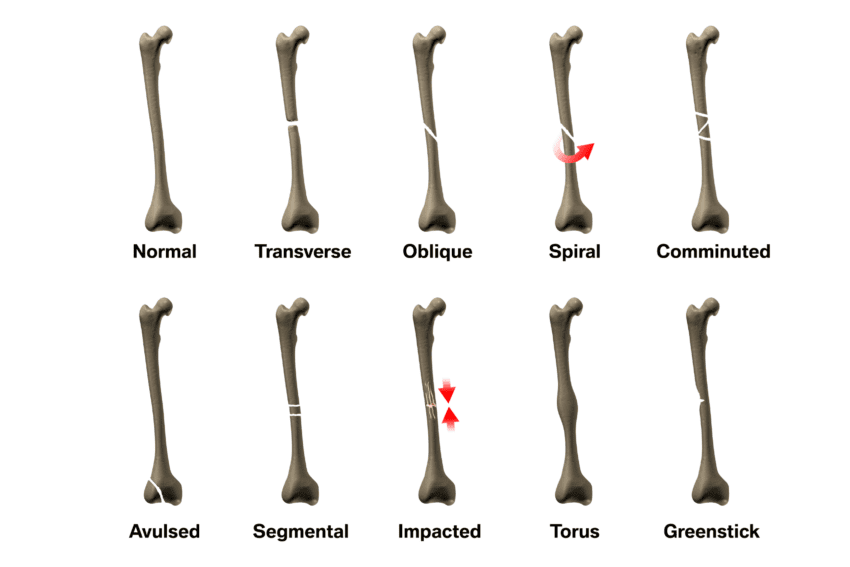 What Are The Different Types Of Fractures at Jake Jordan blog